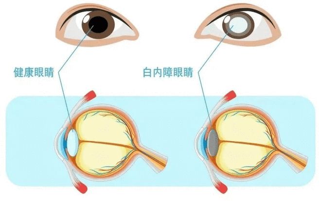 普瑞眼科20周年｜白内障不是“老年病”！合肥普瑞眼科：认识新生儿致盲性眼病先天性白内障